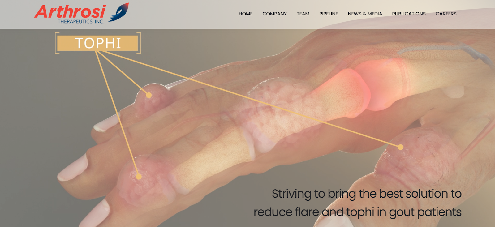 Arthrosi Therapeutics Secures $153 Million in Series E Funding to Redefine Treatment for Gout and Inflammatory Diseases